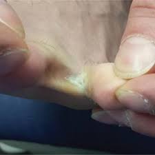 It'll also send a twinge of pain if i carelessly pick something up that loads the ring finger without the pinky. Seven Years Of Pain Between The Toes Clinician Reviews