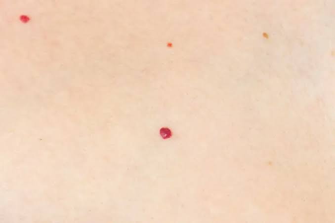 What Causes Little Red Dots on Your Skin?