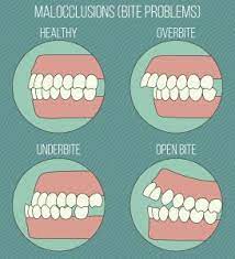 The key to this patients treatment was getting the upper jawbone to be much less prominent. How To Protect Buck Teeth