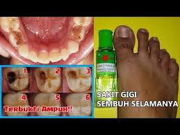 Adapun cara menghilangkan sakit gigi dengan menggunakan garam adalah dengan mencampurnya dengan air hangat kemudian digunakan untuk berkumur. Cara Menyembuhkan Sakit Gigi Dalam 1 Hari Bisabo Channel