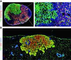 I prefer a sentinel node biopsy in which all the. How Do Metastatic Tumor Cells Grow In Lymph Nodes Eurekalert Science News