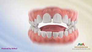 Stopping the habit of tongue thrusting won't correct tooth misalignment, but it will make sure the bite if you're wondering how to close an open bite without braces, you may want to consider invisible aligners like. Orthodontic Treatment For Tongue Thrusting Habit Different Options Youtube