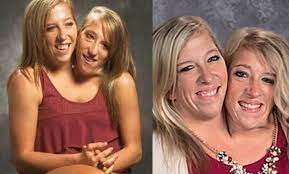 Vários de seus orgãos vitais são duplicados bodybizarre #borndifferent like abby and brittany hensel or carmen and lupita andrade, callie and carter torres are conjoined twins that share the. Abby Brittany Hensel Finally An Answer About Sex Life The Frisky
