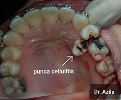 Sedangkan gigi geraham besar pertama rahang bawah biasanya memiliki 2 akar, namun terkadang 3 akar, dengan jumlah total saluran akar bervariasi antara 3 sampai 6 saluran akar. Pakai Braces Lebih Tiga Tahun Sudahnya Bengkak Muka Gigi Rosak Teruk Mingguan Wanita