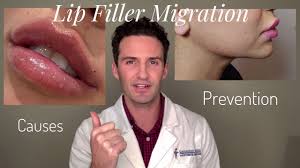 Tailored Peninsula Injectables - Lip Filler Migration. 👄💉💃🏼 A While Ago  I Posted A Little Of My Journey Getting My Own Lips Dissolved After  Noticing Migration. I Went Through All The Same