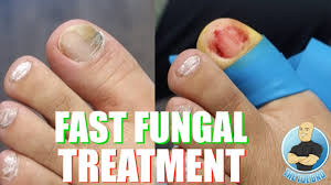 the fastest way to treat toenail fungus