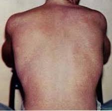 Check spelling or type a new query. Dengue Fever Simple English Wikipedia The Free Encyclopedia