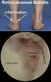 Sometimes an aging body will generate them in an effort to provide more. Retrocalcaneal Bursitis Symptoms Causes Treatment