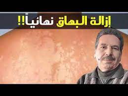 إزالة البهاق نهائيا تصبغ البشرة بسبب الشمس الحل الدكتور جمال الصقلي youtube