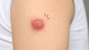 Bisul (furunkel) bisul (furunkel) adalah infeksi kulit yang meliputi seluruh folikel rambut dan jaringan subkutaneus di sekitarnya. Jangan Panik Ini 5 Cara Mengobati Bisul Pada Anak Orami