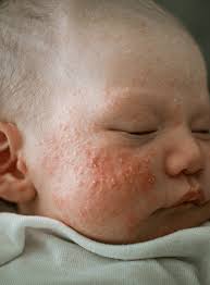 Image result for red rash face