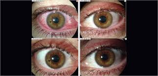 Image result for Acute Red Eye