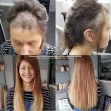 Trichotillomania (hair pulling disorder) is a disorder where an individual repeatedly pulls out one's own hair. Hair Loss Dreamgirlz Hair Extensions