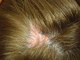 An excision found sebaceous nevus of jadassohn. Autosomal Dominant Transmission Of Nevus Sebaceous Of Jadassohn