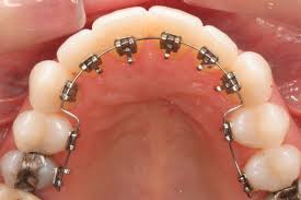 We did not find results for: How Much Do Braces Cost In The Uk The Dental Guide Uk
