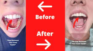 When you first get your braces off or finish your clear aligner treatment, your orthodontist will provide how long a retainer last depends on which retainer type you have, as well as how well you care for the retainer. Byte Review Are Byte Aligners Worth It Honest Review Warmchef Com