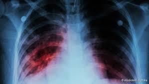 La légionellose est une infection causée par la bactérie legionella pneumophila. Legionarskrankheit Ursachen Symptome Behandlung Netdoktor