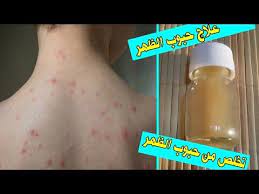 حب الشباب من المشاكل الشائعة جدا حيث تعتبر حبوب التي تظهر في الظهر من اكثر الحبوب صعوبه من حيث العلاج لان الظهر غني بالغ Soap Bottle Hand Soap Bottle Hand Soap