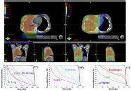 Check spelling or type a new query. Consensus Statement On Proton Therapy In Mesothelioma Sciencedirect