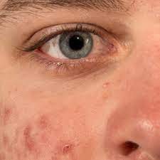 Middle Aged And Acne Ridden Health24