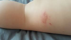 Brown recluse spiders are found most commonly in the southern midwest and in limited areas of the south. Spider Bite January 2016 Babycenter Australia