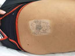 Sun Exposure And Laser Tattoo Removal Questions Answered