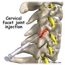 Pain Management Facet Joint Injection Lectura De Facet Joint Linear Unit Castellano