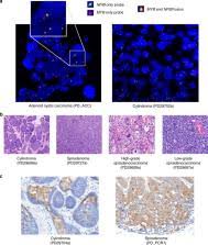 ALPK1 hotspot mutation as a driver of human spiradenoma and  spiradenocarcinoma
