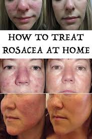 How To Treat Rosacea At Home In 2020 How To Treat Rosacea Rosacea Rosacea Remedies