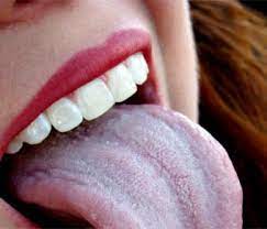 Check spelling or type a new query. Hvit Belegg I Munnen Pangudownloads Com