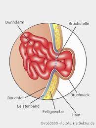 Leistenbruch Symptome Ursachen Behandlung Netdoktor
