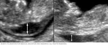 First Trimester Screening Mayo Clinic