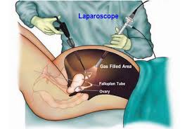 Laparoscopic surgery illustration for ectopic pregnancy in the fallopian tube