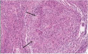 Image result for Pleural Tuberculosis