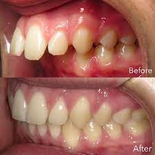 This could mean having too much room in the jaw area or too little room to accommodate one's teeth. Common Orthodontic Problems Overbite Underbite Crowding Gap Etc