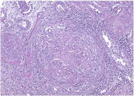 Image result for Microscopic Polyangiitis