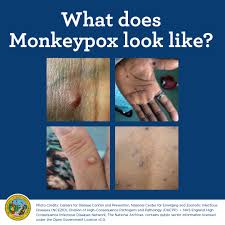 Image result for Monkeypox
