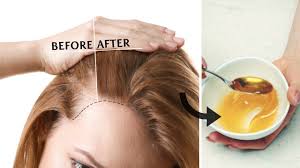 It increases the elasticity of the hair strands that prevents breakage. How To Use Honey Mask For Hair Loss Treatment Youtube