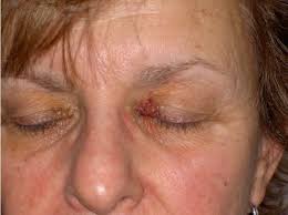 Purpura has a wide array of possible causes that range from a temporary drug side effect to a sign of a serious underlying medical condition. Image Iq Recurrent Eyelid Purpura