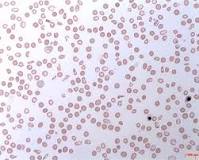 Image result for icd 10 code for pnh