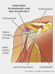 Schleimbeutelentzundung Beschreibung Ursachen Behandlung Netdoktor