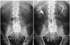 Image result for Intravenous Pyelogram