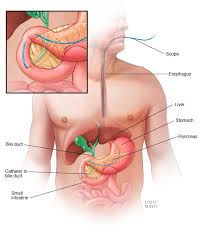 Image result for Gallstone