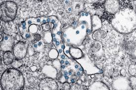 But several other disease conditions may also have this feature including atelectasis, intrapulmonary shunt, intracardiac. Happy Hypoxia Mystifies Experts In Some Covid 19 Patients Phillyvoice