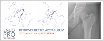 Image result for Femoral Retroversion