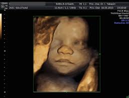 Ab wann ist ein 3d ultraschall sinnvoll??!! Warum Pranataldiagnostik Dr Tekesin