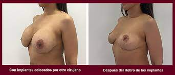 Retiro de Implantes Mamarios – Dr. Fabian Cuevas