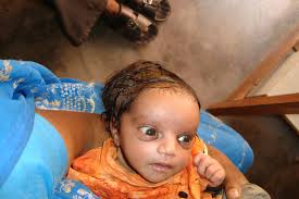 Image result for Cephalhematoma