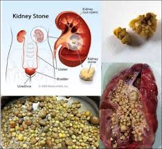 Anda mengalami simptom atau sudah disahkan ada batu karang? ketahui bagaimana seorang doktor (pakar herba) menemui formula 'unik' mencampurkan beberapa herba. Biar Betul Makan Suplemen Berlebihan Punca Terjadinya Batu Karang