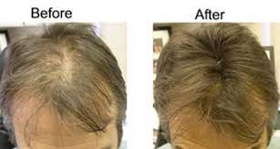 If your hair is thinning, do not fret. New Thinning Hair Loss Treatment Found With Instant Hair Fibers Pressreleasepoint
